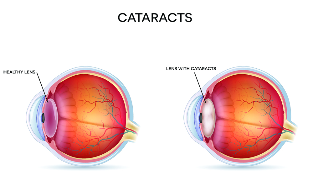 cataract