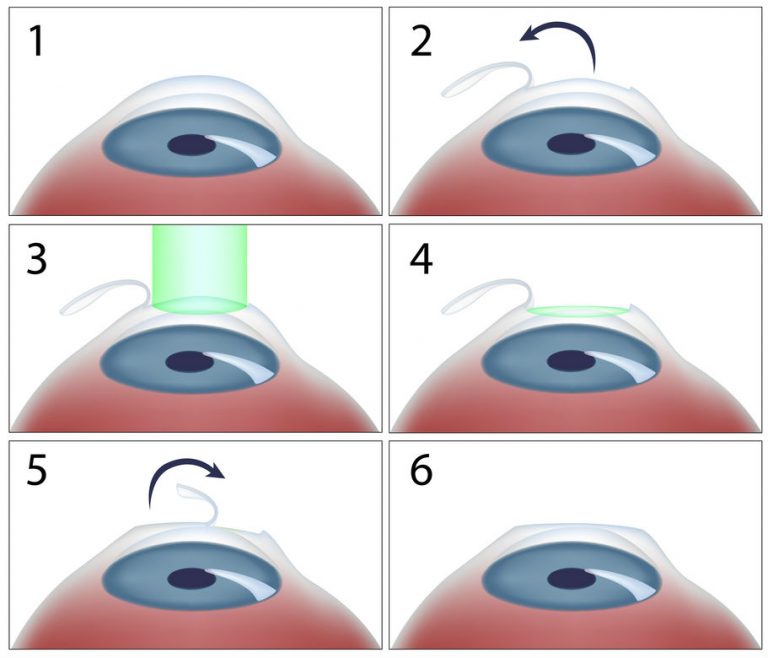 lasiksurgery