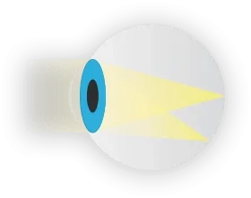 Astigmatism