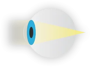 Presbyopia